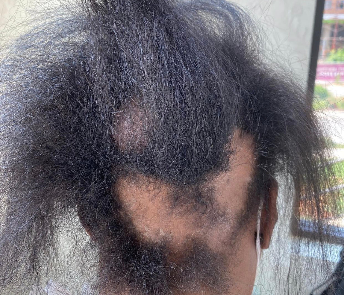 ALOPECIA… Especially on Woman of Color